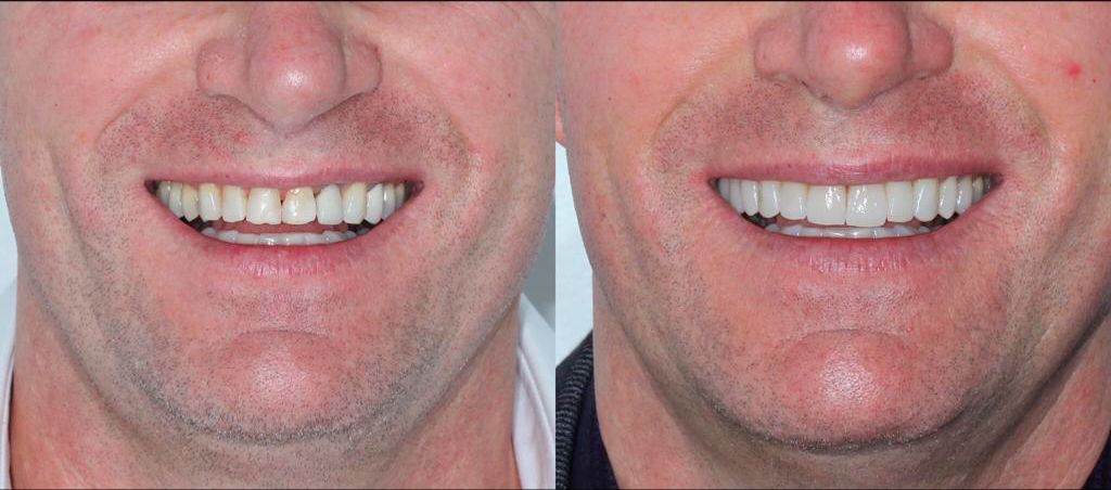 Resultado de antes e depois — transformação 1