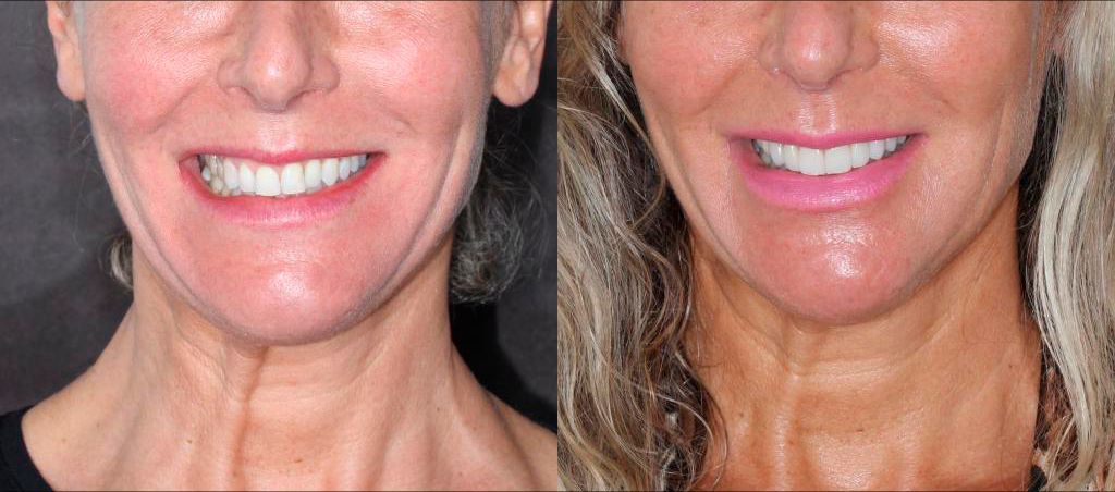 Resultado de antes e depois — transformação 2