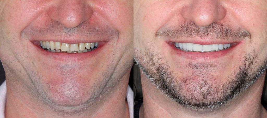 Resultado de antes e depois — transformação 3