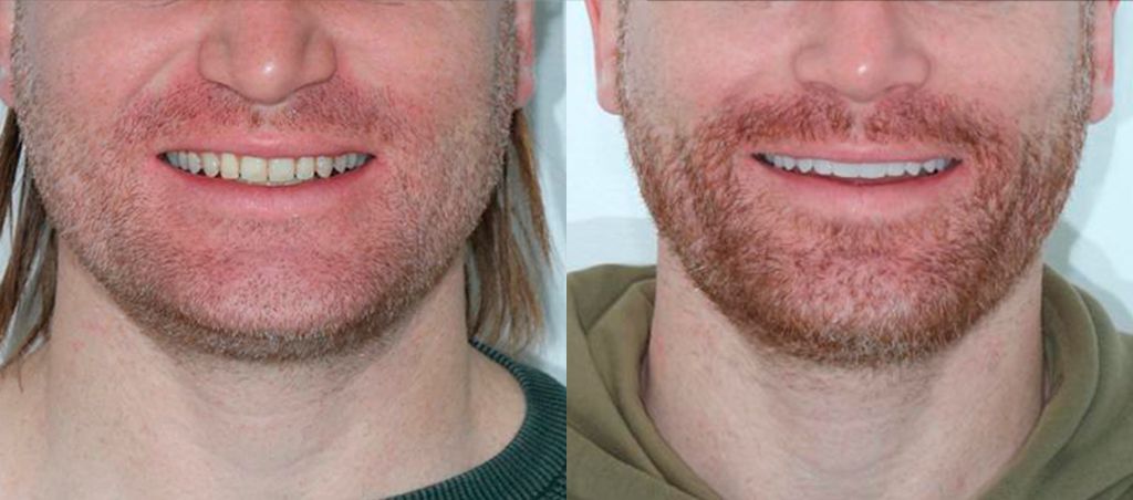 Resultado de antes e depois — transformação 4