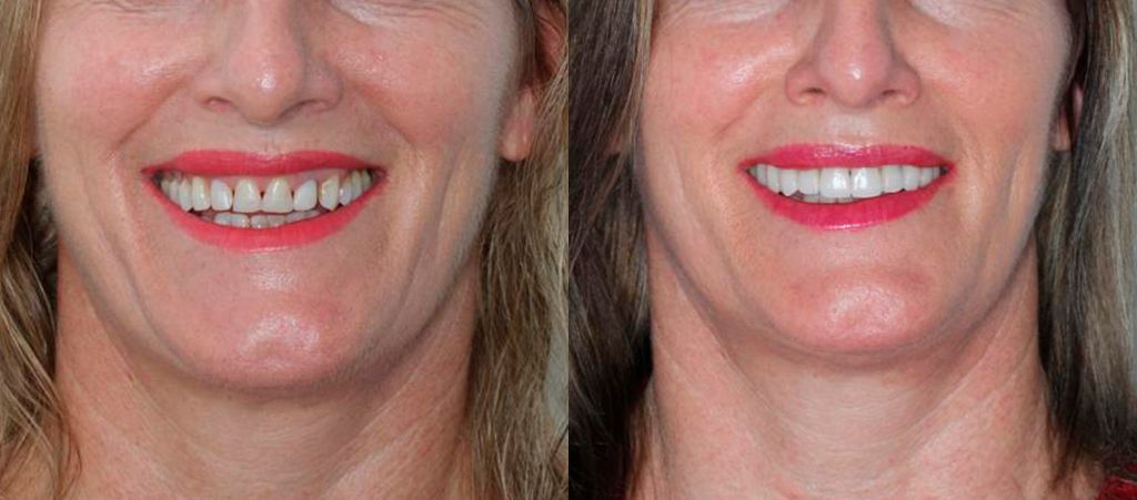 Resultado de antes e depois — transformação 5