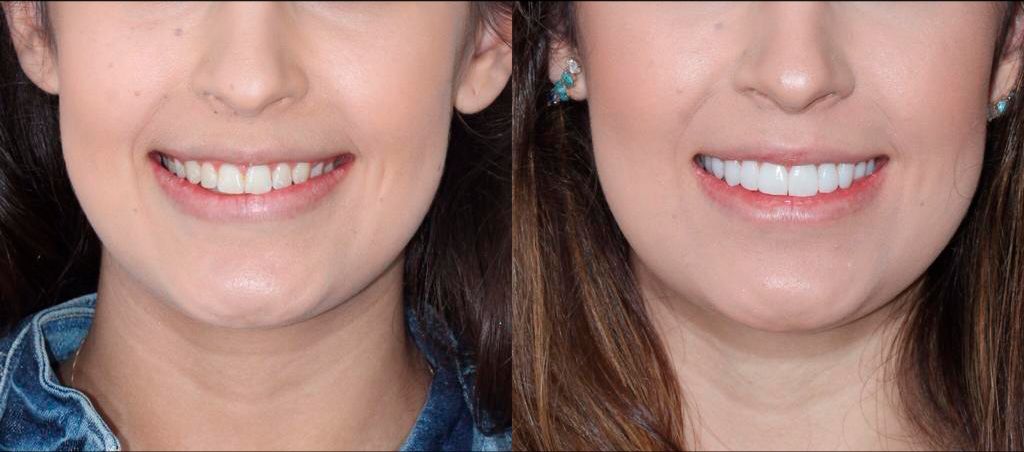 Resultado de antes e depois — transformação 6